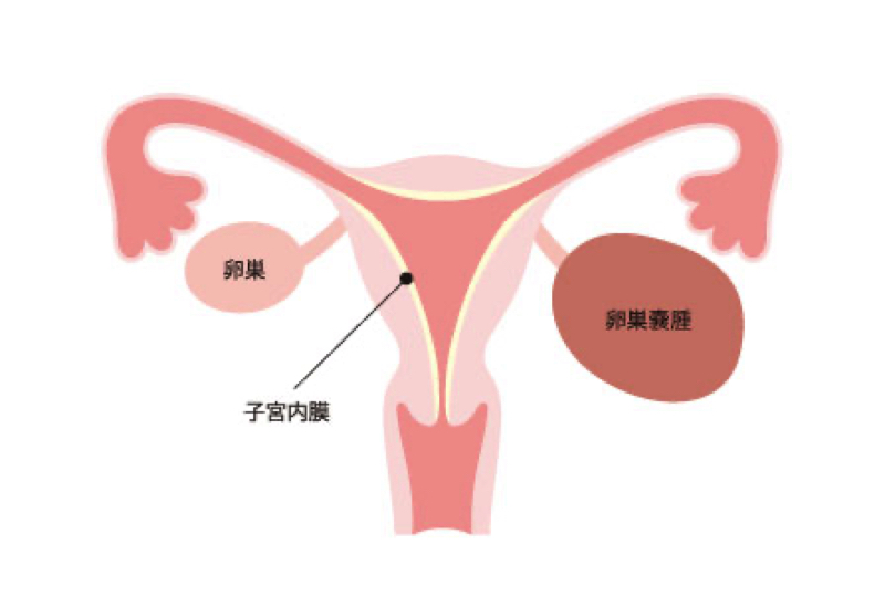 卵巣嚢腫
